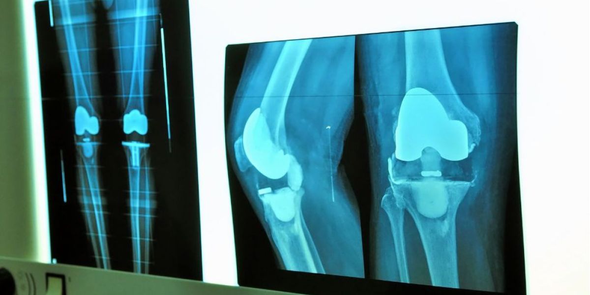 protesi al ginocchio